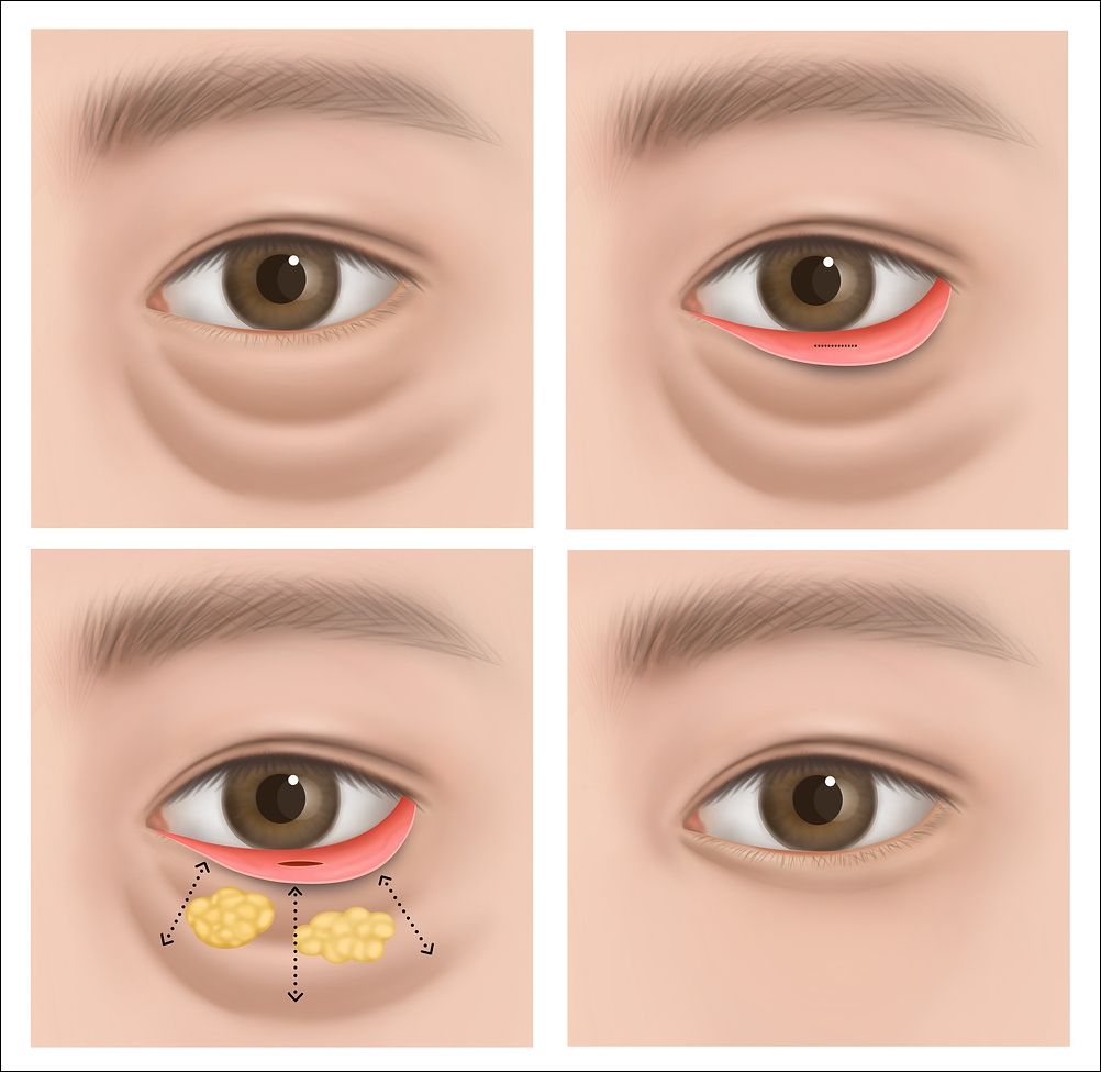 눈밑지방재배치