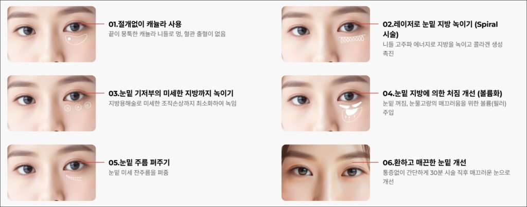 눈밑지방재배치