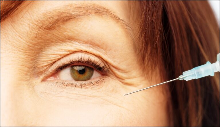 눈가주름 보톡스