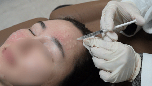 스킨보톡스엠보싱기간