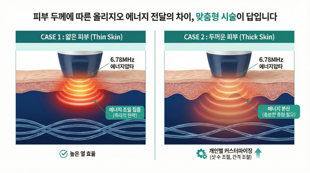 올리지오레이저