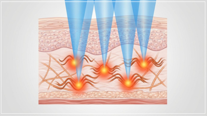 울쎄라 저렴한곳 찾으시나요? 결과가 엇갈리는 이유는 무엇일까요?