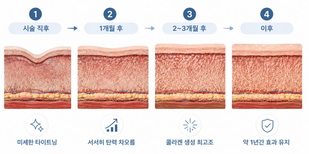 시술 직후부터 1년 유지 기간까지의 수원 소프웨이브 효과 발현 시기 타임라인